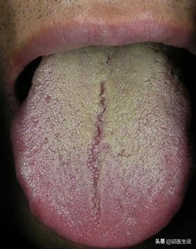 湿热寒湿痰湿并存怎么调理,寒湿型湿气