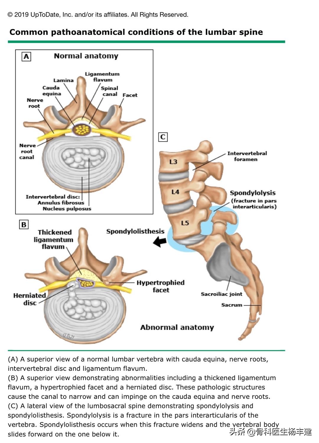 50多岁的人腰痛用什么膏药,癌症引起的腰疼贴什么膏药
