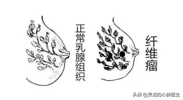 乳腺纤维瘤是实证还是虚证,乳腺纤维瘤是实性的还是囊性的
