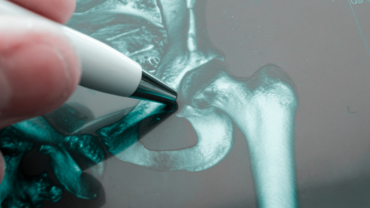 关节置换术后假体周围感染,关节置换后感染医院有责任吗