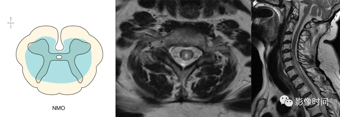 脊髓病变案例图文问诊,脊髓病变视频