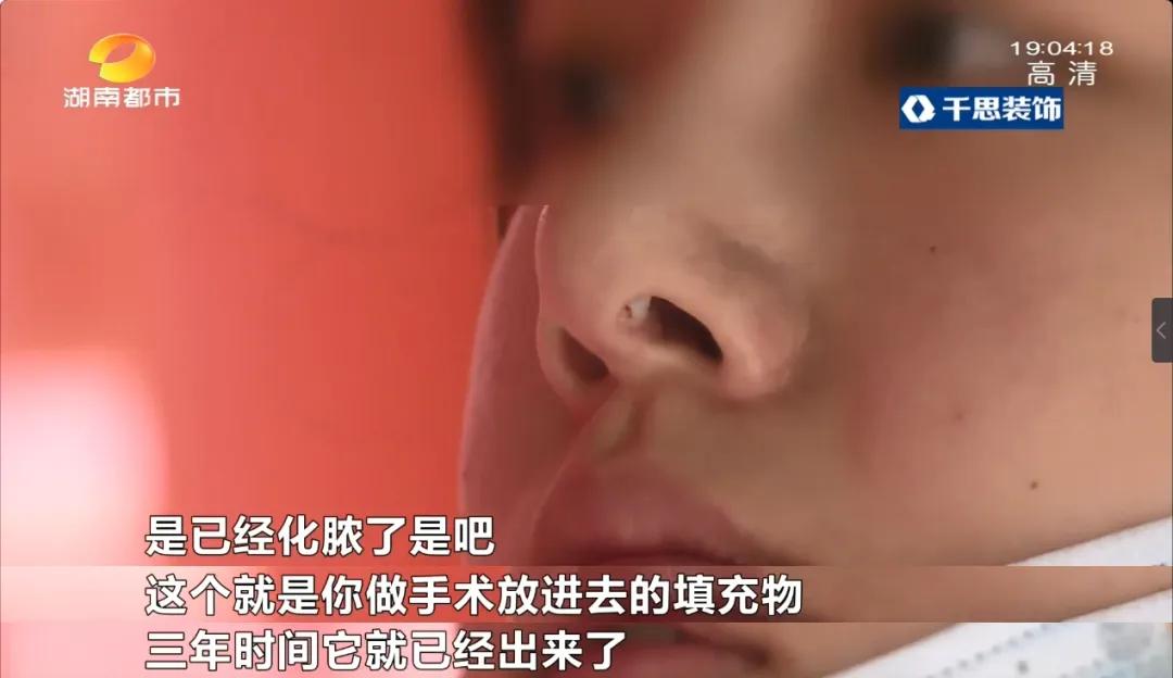 隆鼻后怀孕假体外露,女子怀孕鼻子假体外露