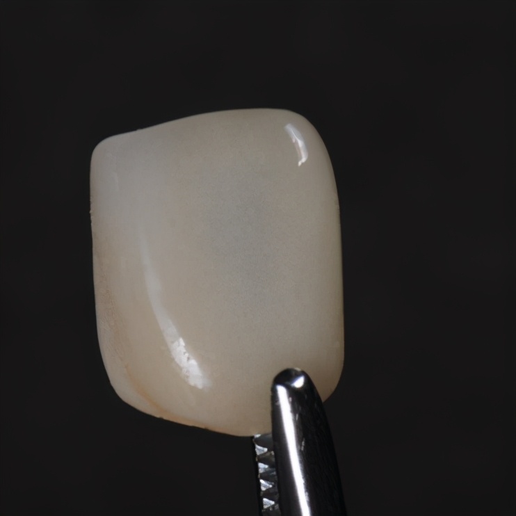 树脂贴面和烤瓷贴区别,贴面树脂的好还是烤瓷的好