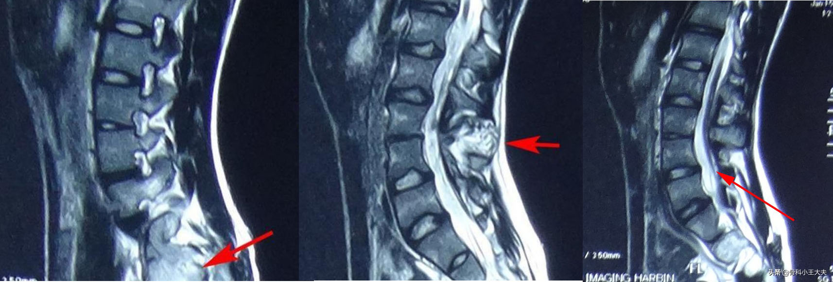成年人脊柱歪,成年人脊椎弯了怎么办