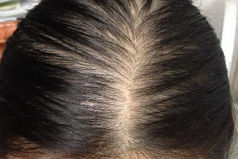 脂溢性脱发治愈脱发实例,脂溢性脱发治疗初期脱发更严重