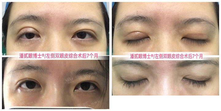 双眼皮手术后问题,双眼皮术后怎么才知道恢复好了没