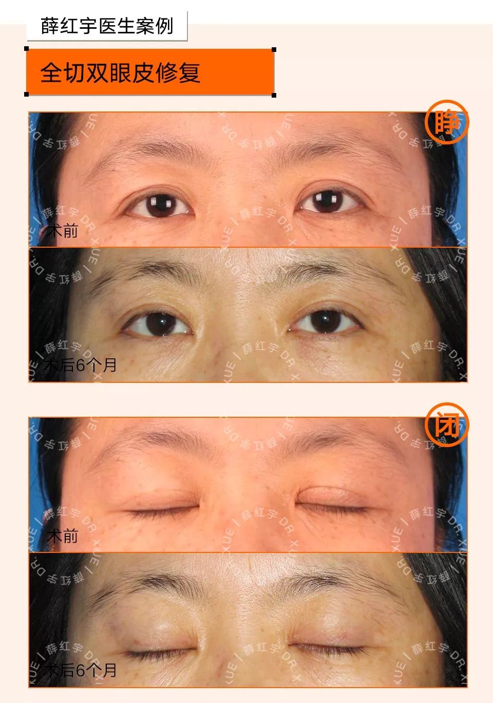 双眼皮整形修复,潘贰双眼皮修复