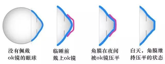 小孩200度真近视有必要佩戴ok镜吗,除了ok镜还有什么镜可以延缓近视