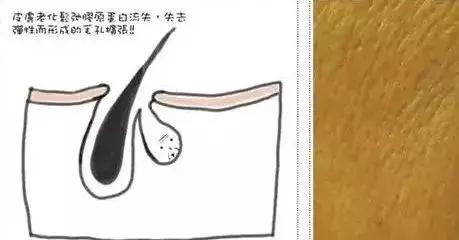 万年毛孔去不掉？那是你没用对方法