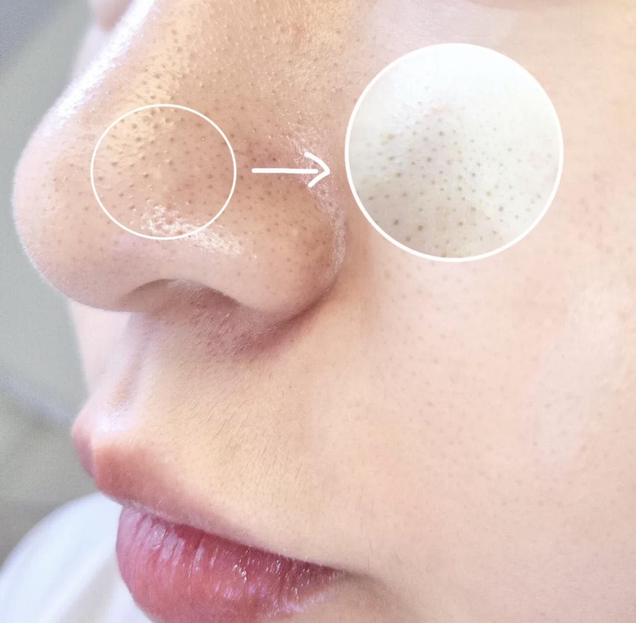 去黑头的几大“雷品”!城野医生用处不大,黑炭硬撕你敢用?