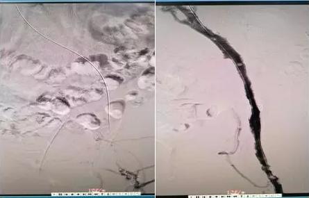 深静脉血栓应该看什么科,深静脉血栓哪个医院治疗最好