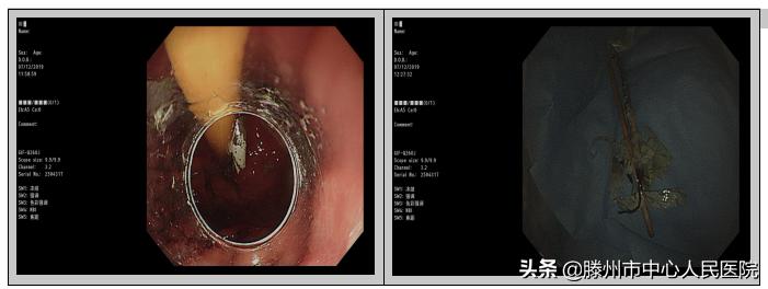 内镜下成功取出食管异物,消化内科取异物