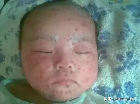 麻疹样幼儿急疹,麻疹风疹幼儿急疹的鉴别点有哪些