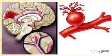 急性缺血性脑卒中血压管理,出血性脑卒中的急救