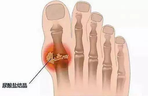 高尿酸关节痛用什么药,高尿酸导致关节疼吃什么药