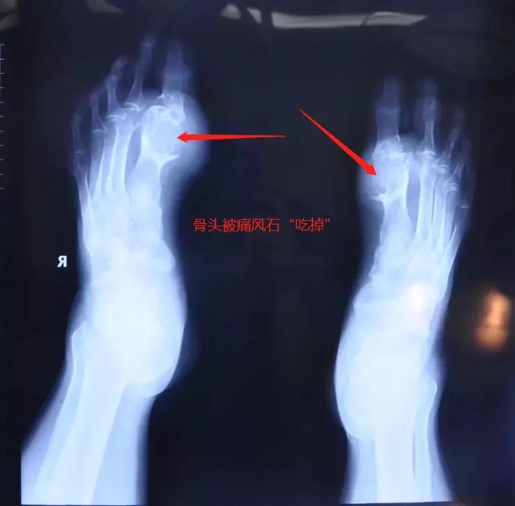 痛风脚踝有痛风石怎样才能变小,痛风石是引起痛风的根本原因吗