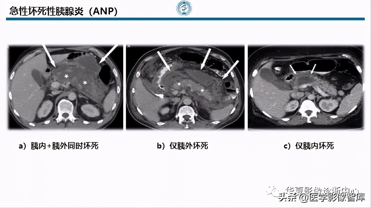 核磁ct都显示急性胰腺炎,急性坏死性胰腺炎的ct表现