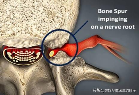 有些患者膝盖疼痛是由腰椎间盘突出压迫神经导致的,千万别忽视