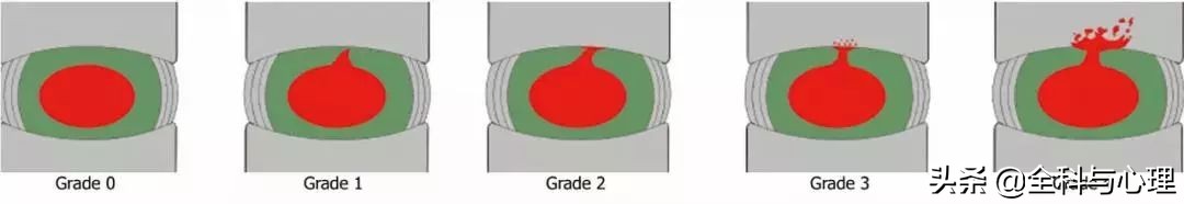 腰痛要警惕四种原因肾不好,盘点腰痛常见病因及防治训练