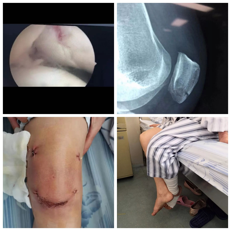 阿婆路边摔伤,阿婆骨折手术