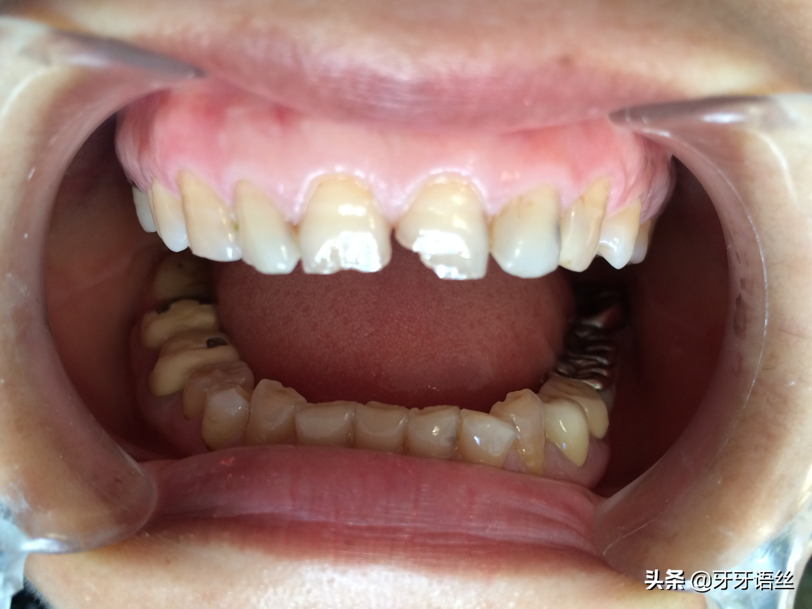 牙断了需要根管治疗吗,儿童牙齿断了剩一点怎么处理