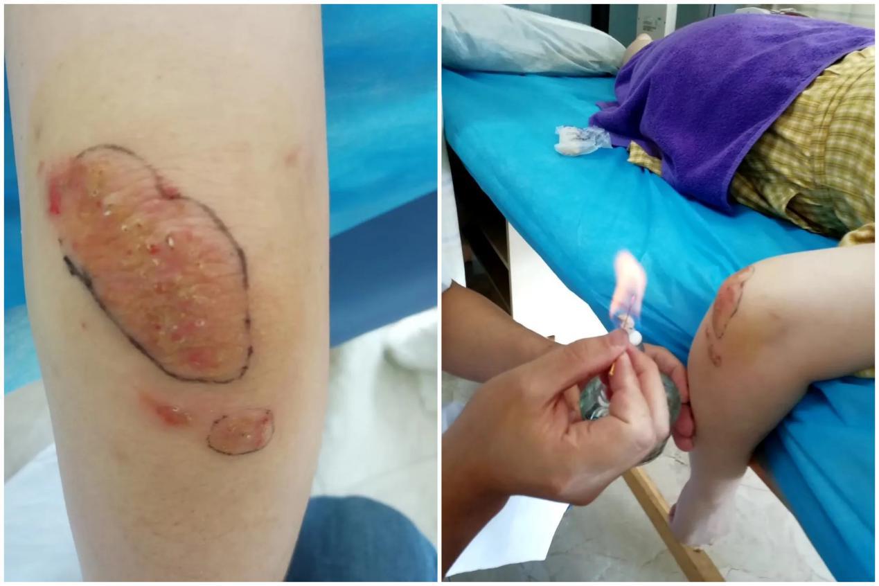 火针治疗神经性皮炎的原理是,在医院一般怎么治神经性皮炎