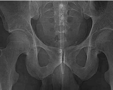 不作死就不会死,看看这些被人类搞进身体里的异物