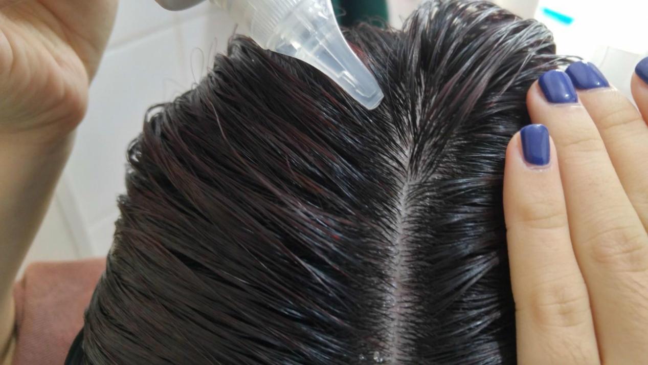 头皮屑反反复复发作怎么办,头皮屑反复发作是什么原因