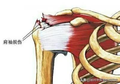 肩膀疼痛、肩周炎的你还在甩肩锻炼吗？早诊断好治疗