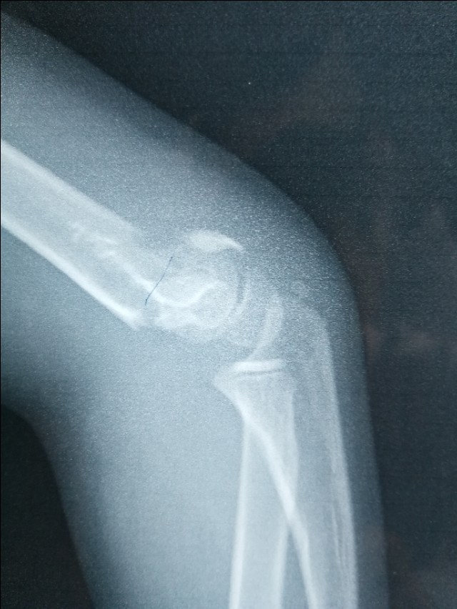 骨折的微创手术有后遗症吗,骨折的微创手术需要多少钱