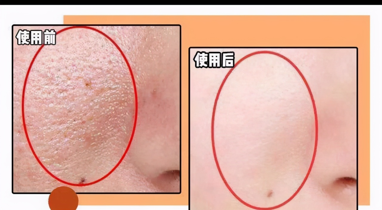 宝露斯毛孔收细套：赋活嫩滑肌肤、收缩毛孔渐平滑