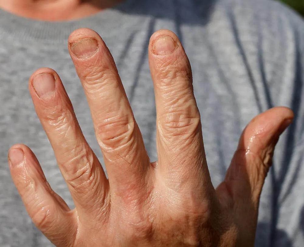 手脚总是起水泡疹 (手脚长了很多水泡还有丘疹)