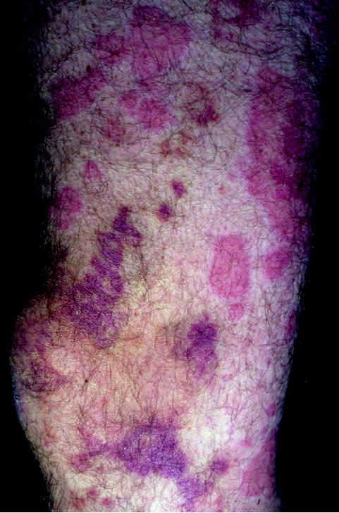 过敏性紫癜算是风湿病的一种吗,风湿性关节炎与过敏性紫癜区别