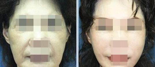 浙江阿姨拉皮手术,经典拉皮手术