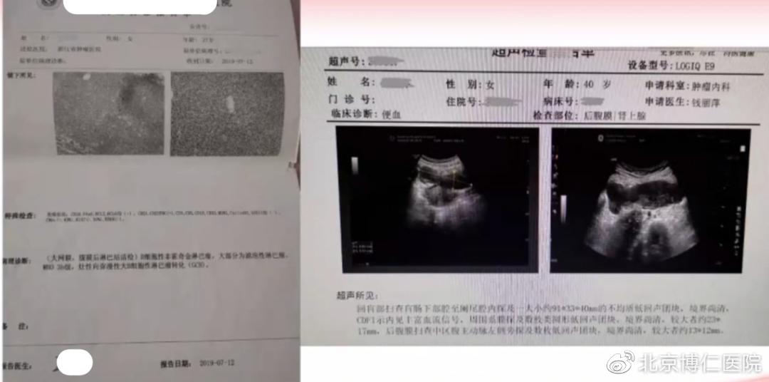 确诊淋巴瘤的最可靠依据是什么,淋巴瘤预后差有治疗必要吗