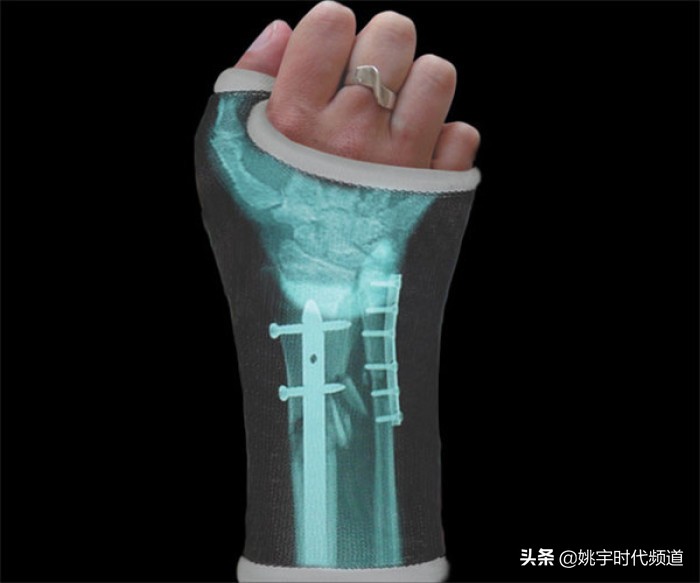 骨折了要注意哪些事情,骨折后得做什么准备