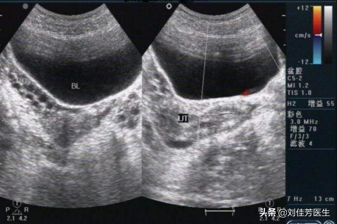 多囊是怎么诊断出来的,造成多囊的原因有哪些