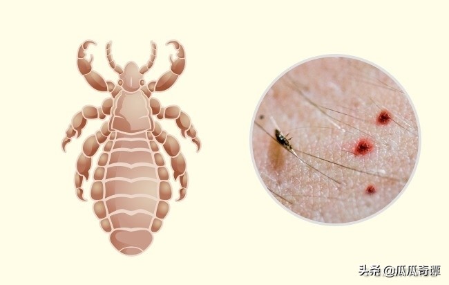 夏季蚊虫叮咬教你一招轻松解决,各种昆虫叮咬清晰图片对照表