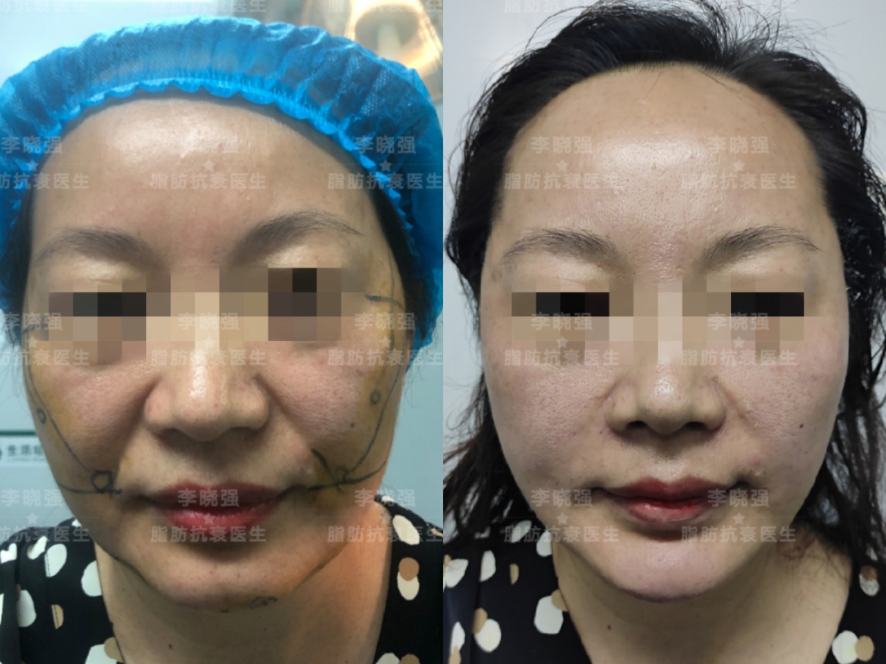 面部线雕的最终效果,面部线雕提升案例后的变化