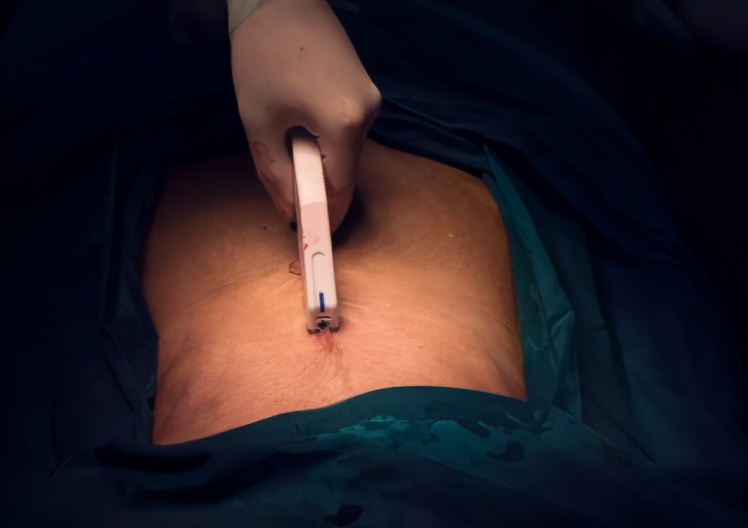 剖腹产妈妈,面临的五大“关卡”,宝爸怎么做才能陪宝妈顺利度过