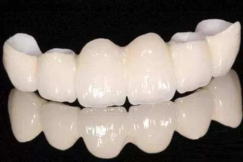 烤瓷牙取下来不戴会有影响吗,烤瓷牙需要把旁边牙齿全弄掉嘛