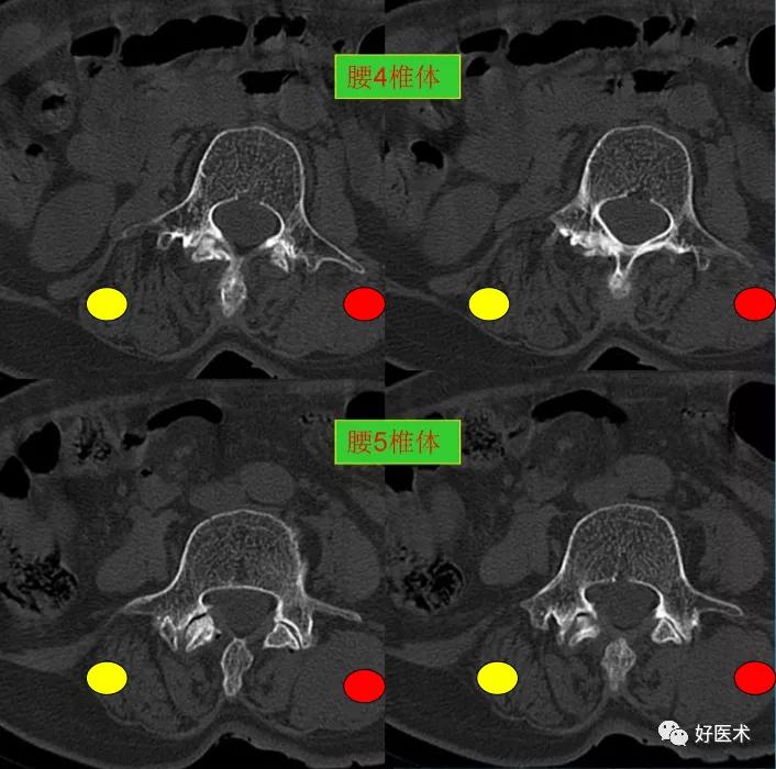 腰部ct需要注意事项,做腰部ct需要注意的事项