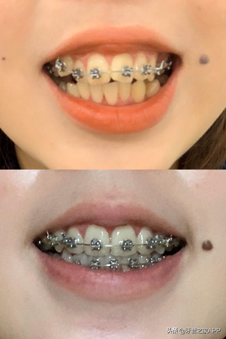 不靠整容怎么改变下巴后缩?看这里