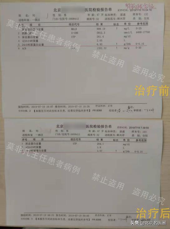 原发性肾病综合征也要吃激素吗,肾病综合征糖皮质激素用药