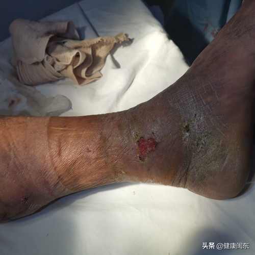 闽东医院开展腔镜下穿通支静脉离断硬化剂治疗老烂腿