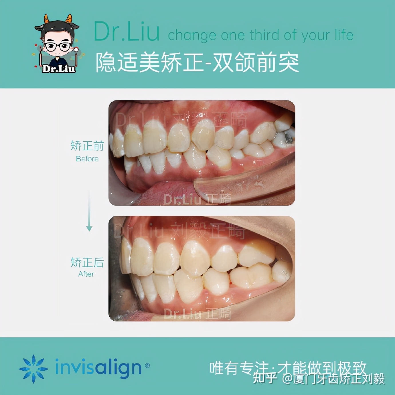 厦门成年人牙齿舌侧矫正,下嘴唇厚且外翻牙齿矫正