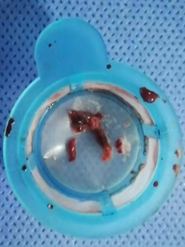 心梗猝死还能救治吗,突发心梗最怕做这10件事