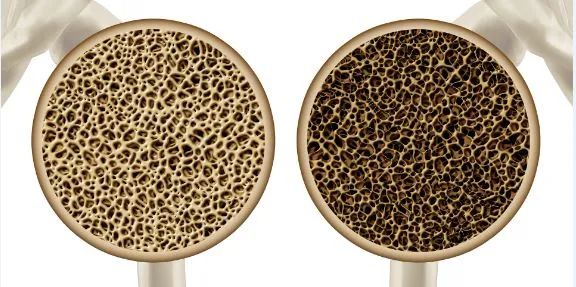 糖尿病和骨质疏松的克星,糖尿病人骨质疏松怎么回事