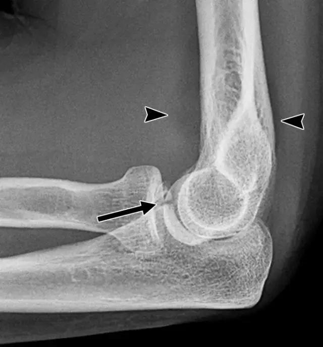 骨折处出现麻痹感,骨折跟精神状态有关