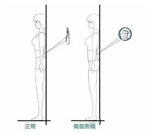 什么是骨盆前倾和后倾图片,男性骨盆前倾是什么样的